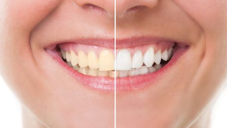 blanqueamiento dental en Culleredo, carillas dentales en Culleredo.