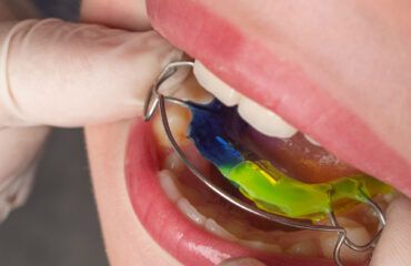 Qué es la ortodoncia interceptiva Clínica Dental Gingiden ¿Qué es la ortodoncia interceptiva? - Clínica Dental Gingiden