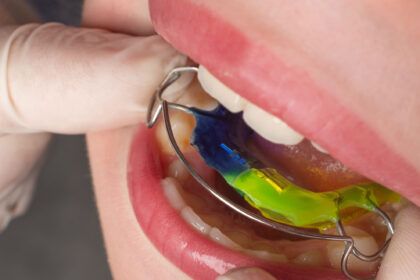 ¿Qué es la ortodoncia interceptiva? - Clínica Dental Gingiden