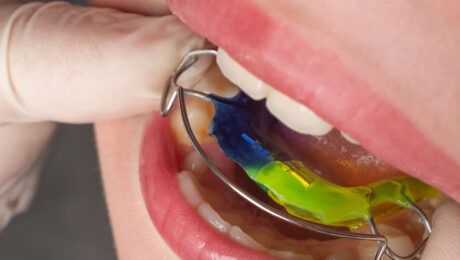 Qué es la ortodoncia interceptiva Clínica Dental Gingiden ¿Qué es la ortodoncia interceptiva? - Clínica Dental Gingiden