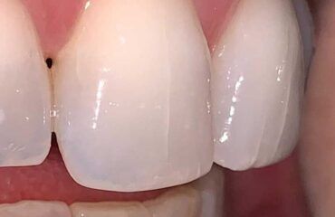 grietas en los dientes grietas en los dientes