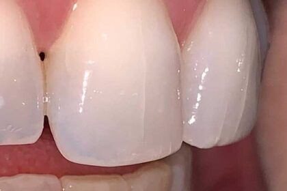 grietas en los dientes