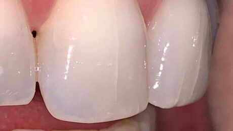 grietas en los dientes grietas en los dientes