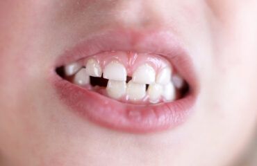 impacto de las caries en el crecimiento de los niños impacto de las caries en el crecimiento de los niños