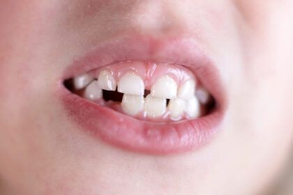 impacto de las caries en el crecimiento de los niños