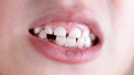 impacto de las caries en el crecimiento de los niños
