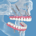 implantes cigomáticos