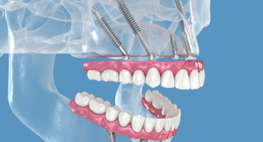 implantes cigomáticos