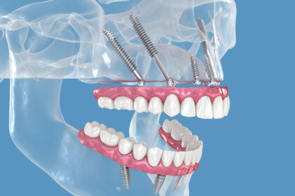 implantes cigomáticos