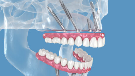 implantes cigomáticos