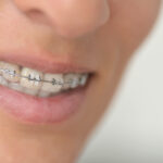 Ortodoncia y salud periodontal