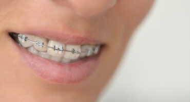 Ortodoncia y salud periodontal