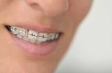 Ortodoncia y salud periodontal