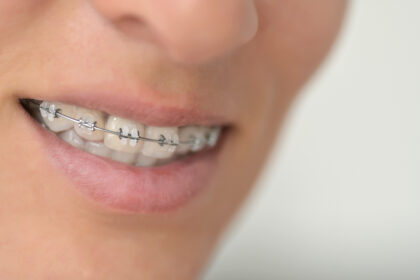 Ortodoncia y salud periodontal