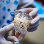 El bruxismo afecta a los implantes dentales