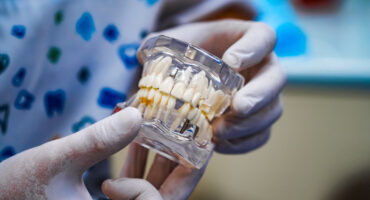 El bruxismo afecta a los implantes dentales