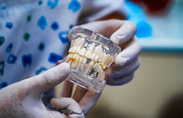 El bruxismo afecta a los implantes dentales El bruxismo afecta a los implantes dentales