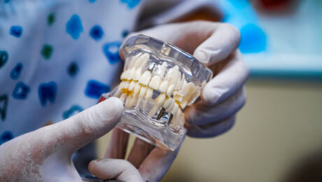 El bruxismo afecta a los implantes dentales