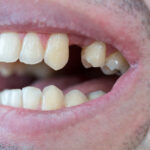 falta una pieza dental