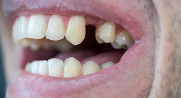 falta una pieza dental
