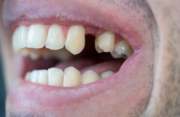 falta una pieza dental falta una pieza dental