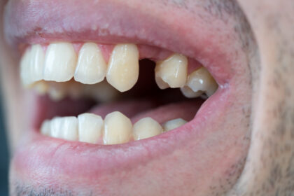 falta una pieza dental