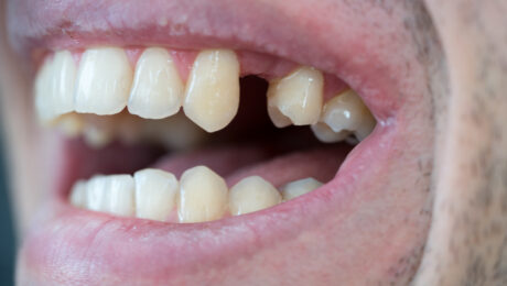 falta una pieza dental falta una pieza dental